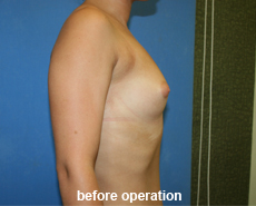 plastic-surgery-breast-augmentation